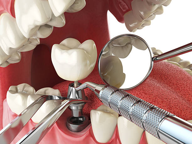 Best Emergency Dentist for Lost Fillings or Crowns in Morgantown, MS